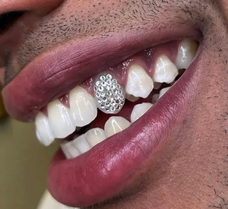 strass-dentaires (3)