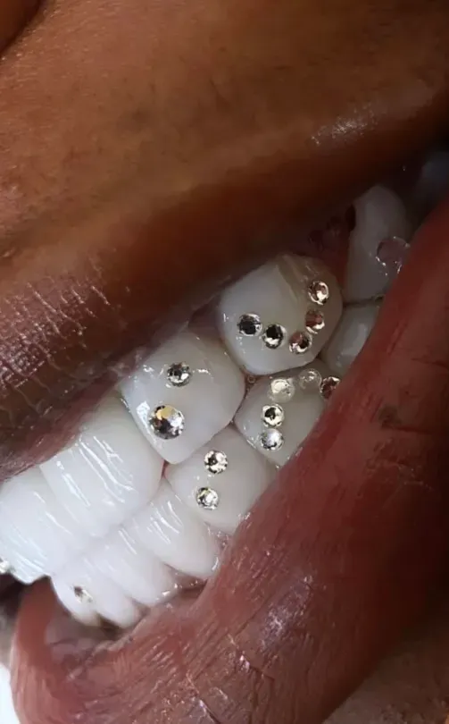 strass-dentaires (2)